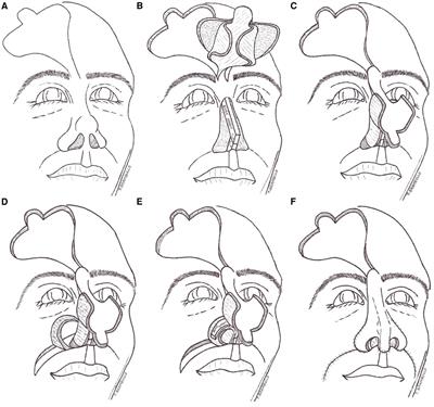 Case Report: A new variant of the forehead flap for subtotal nose reconstruction in a single stage: the dragonfly flap